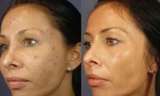 Before &After